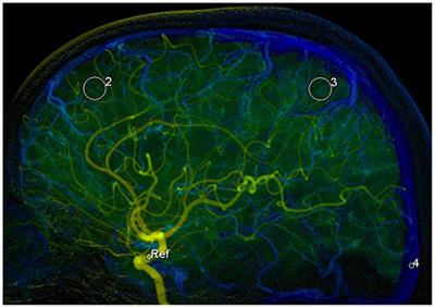 Early Microcirculatory Hemodynamic Changes Are Correlated With Functional Outcomes at Discharge in Patients With Aneurysmal SAH